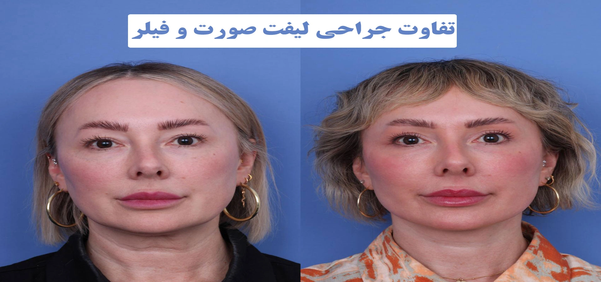 تفاوت جراحی لیفت صورت و فیلر