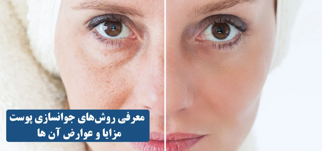 معرفی روش های جوانسازی پوست و مزایا و عوارض آن ها (1)