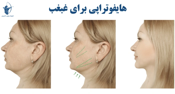 هایفو برای غبغب