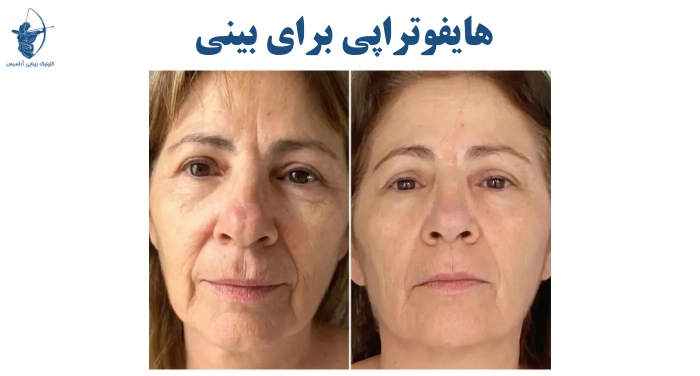 هایفوتراپی برای بینی 