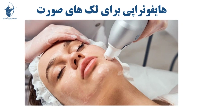 هایفوتراپی برای لک‌های صورت