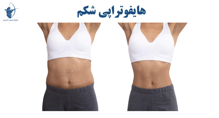 هایفوتراپی شکم