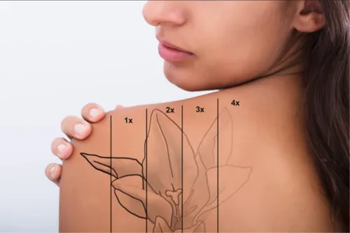 پاک کردن تتو