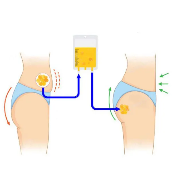 تزریق چربی به باسن