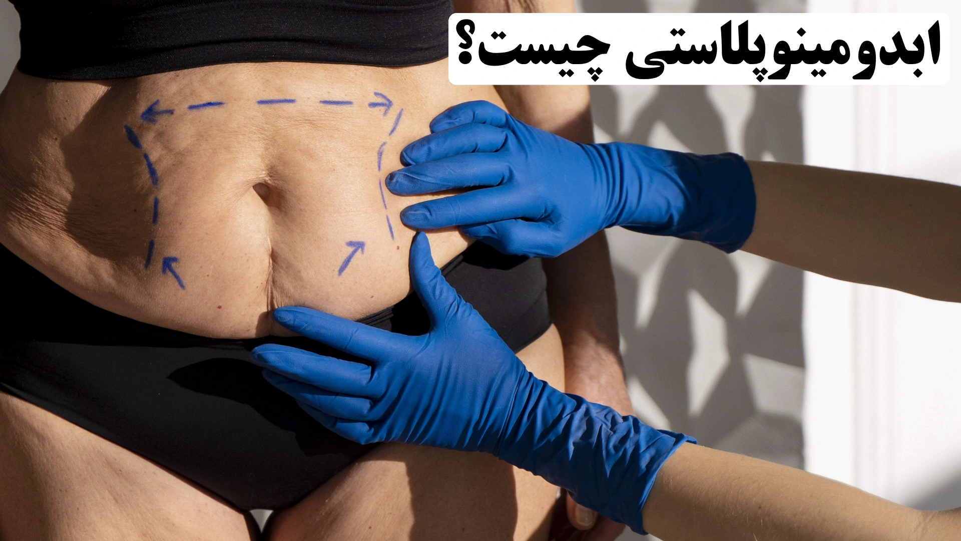 ابدومینوپلاستی چیست؟