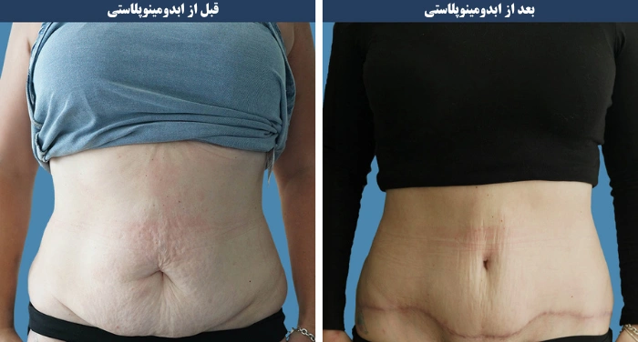 مزایای ابدومینوپلاستی چیست؟